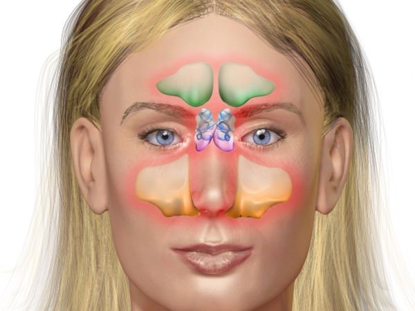 Sinusitis: Nasennebenhöhlen