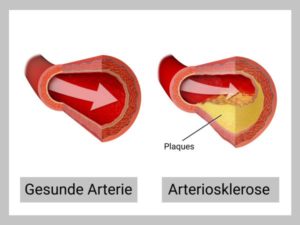 Arteriosklerose vorbeugen: Risikofaktoren für Arterienverkalkung