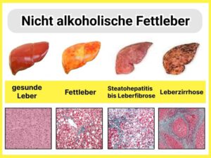 Gesunde Leber, Fettleber, Leberfibrose, Leberzirrhose