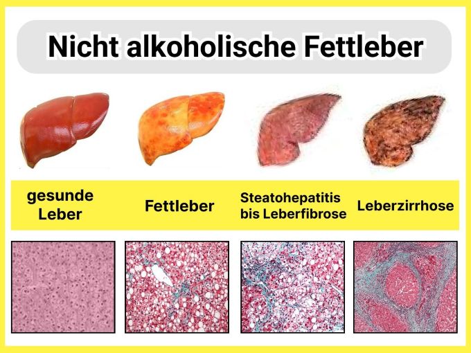 Gesunde Leber, Fettleber, Leberfibrose, Leberzirrhose